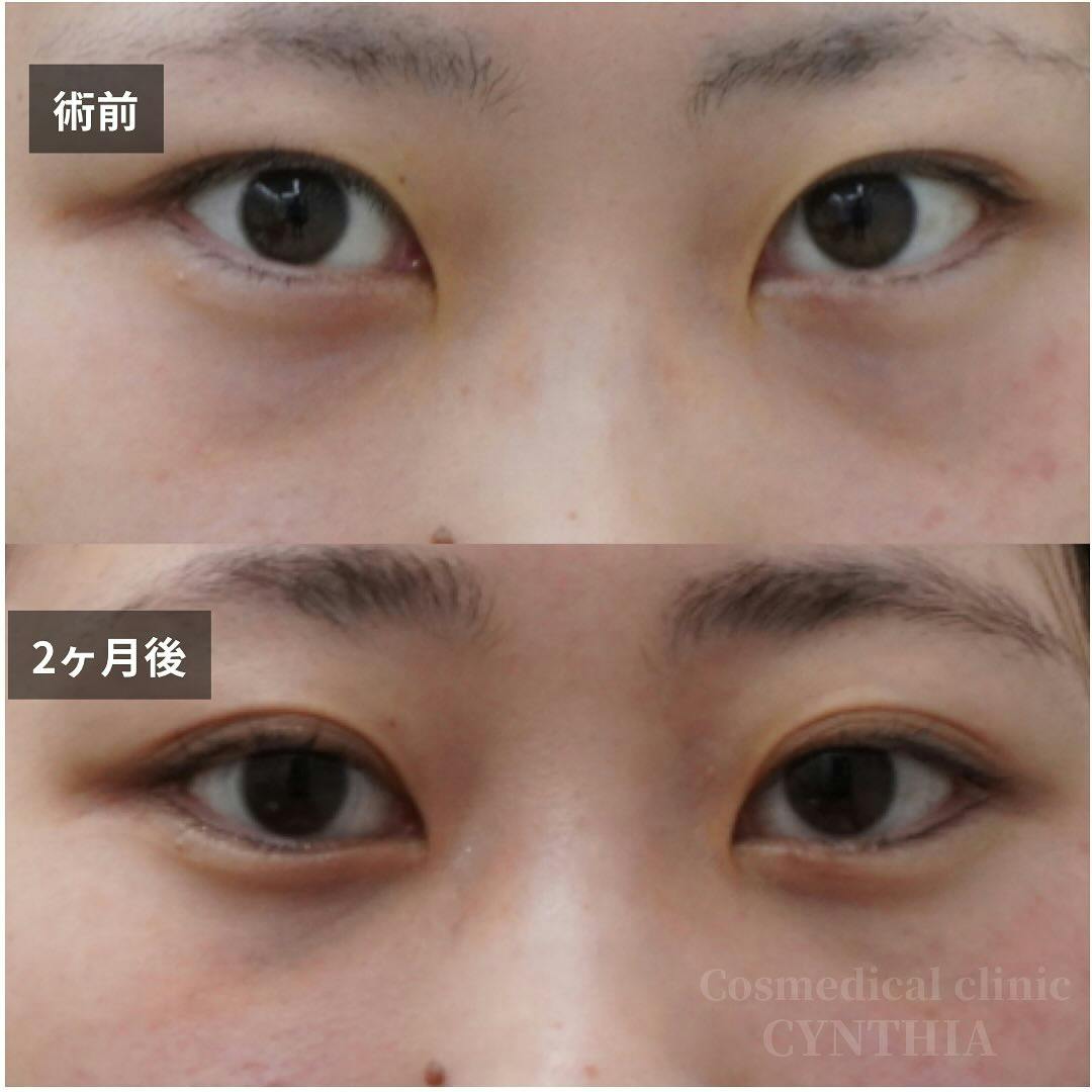 【20代女性・目元】目の下のクマ・たるみ取り_before_aftar