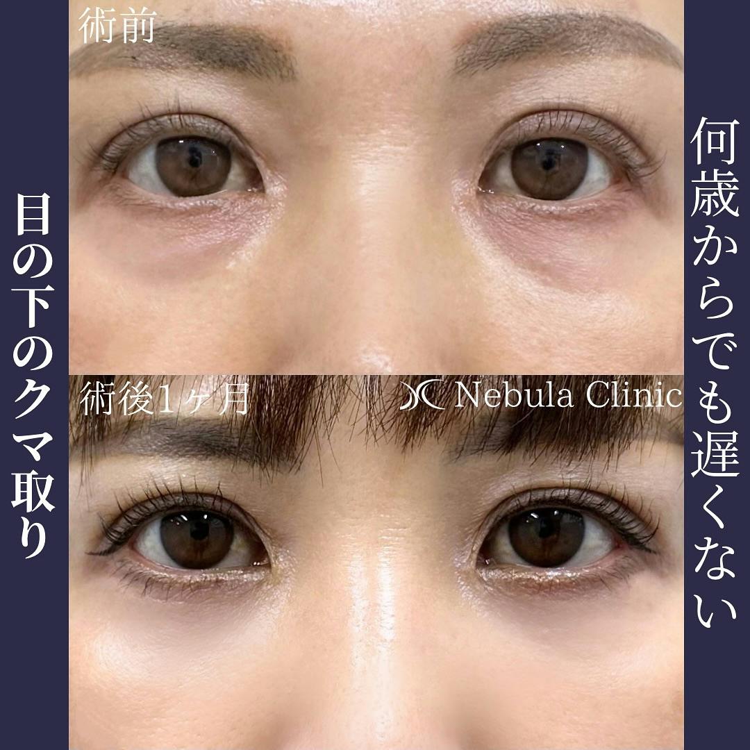 【女性・クマ】切らない目の下のクマ取り・たるみ取り_before_aftar