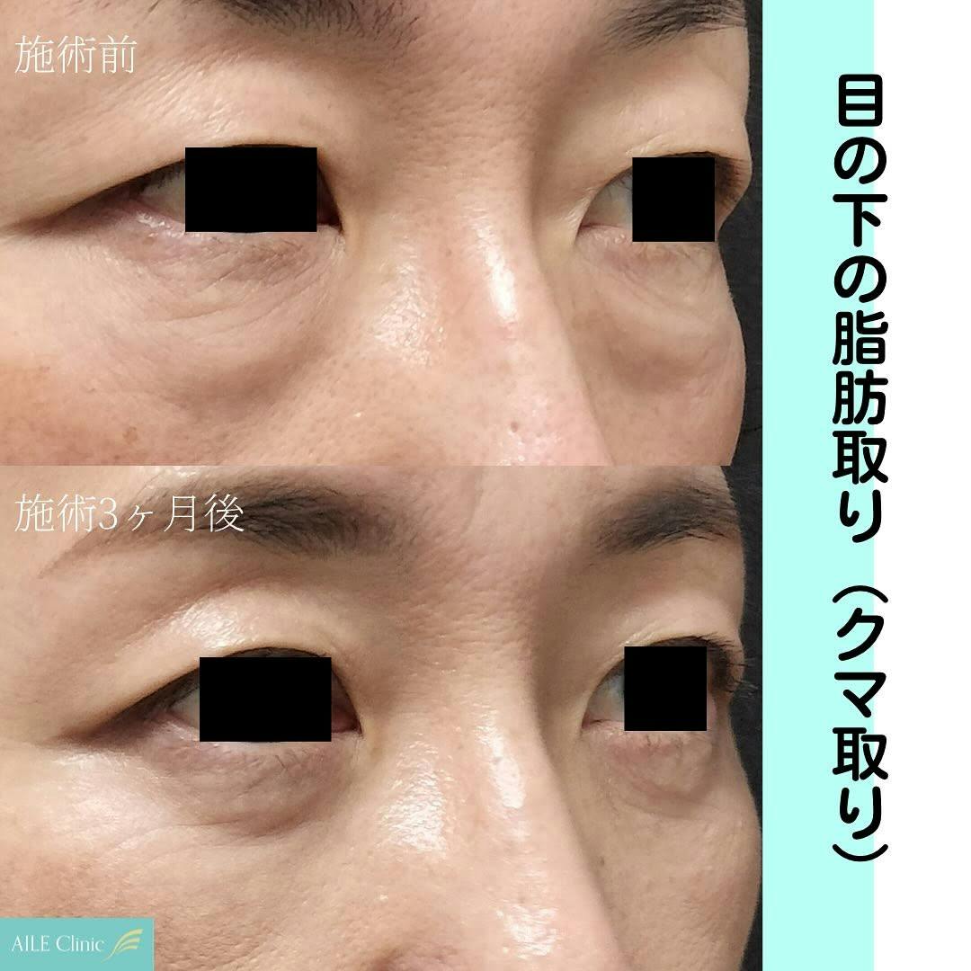 【クマ】目の下の脂肪取り(クマ取り)_before_aftar