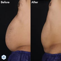 【男性・腹部】クールスカルプティング_before_aftar