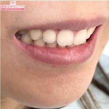 【歯】ホームホワイトニング マウスピース矯正_aftar