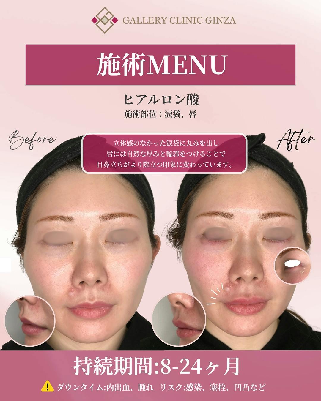 【女性・顔】ヒアルロン酸(涙袋・唇)_before_aftar