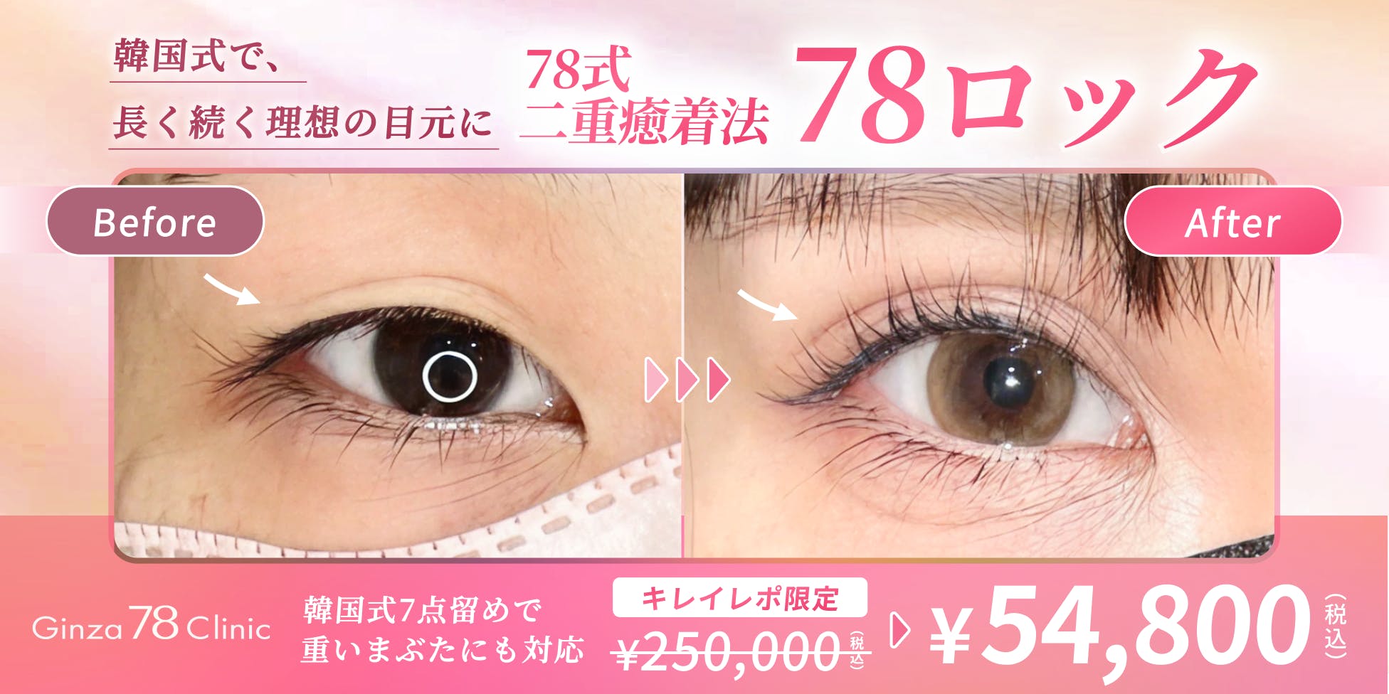 二重自然癒着法 | 韓国式7点留め二重埋没法