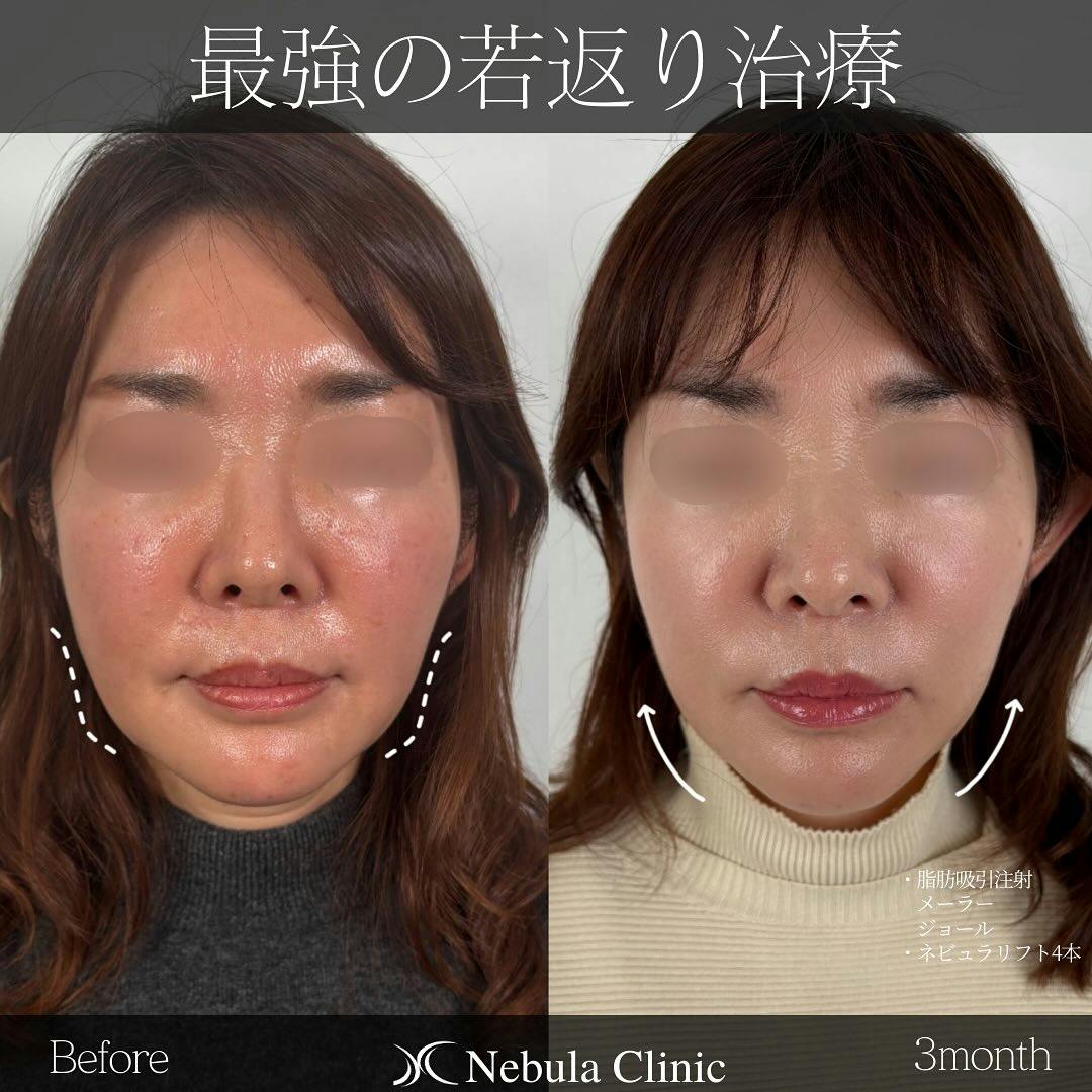 【女性・顔】脂肪吸引(メーラー・ジョール)、糸リフト_before_aftar