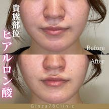 【女性・頬】ヒアルロン酸_before_aftar
