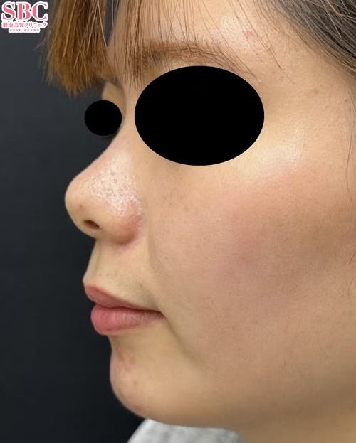 【女性・輪郭】ヒアルロン酸ウルトラディープ_before