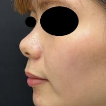 【女性・輪郭】ヒアルロン酸ウルトラディープ_before