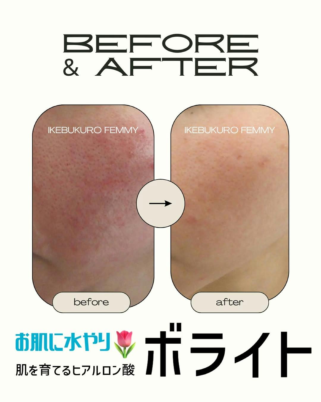 フェミークリニック 池袋院_before_aftar