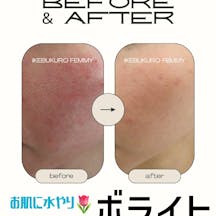 フェミークリニック 池袋院_before_aftar