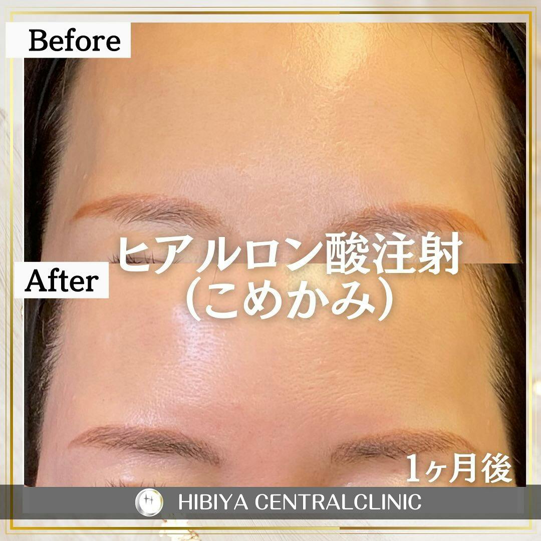 【女性・額】ヒアルロン酸注射_before_aftar