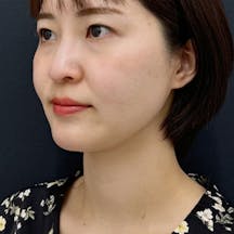 【20代女性・輪郭】根こそぎVASER脂肪吸引_after