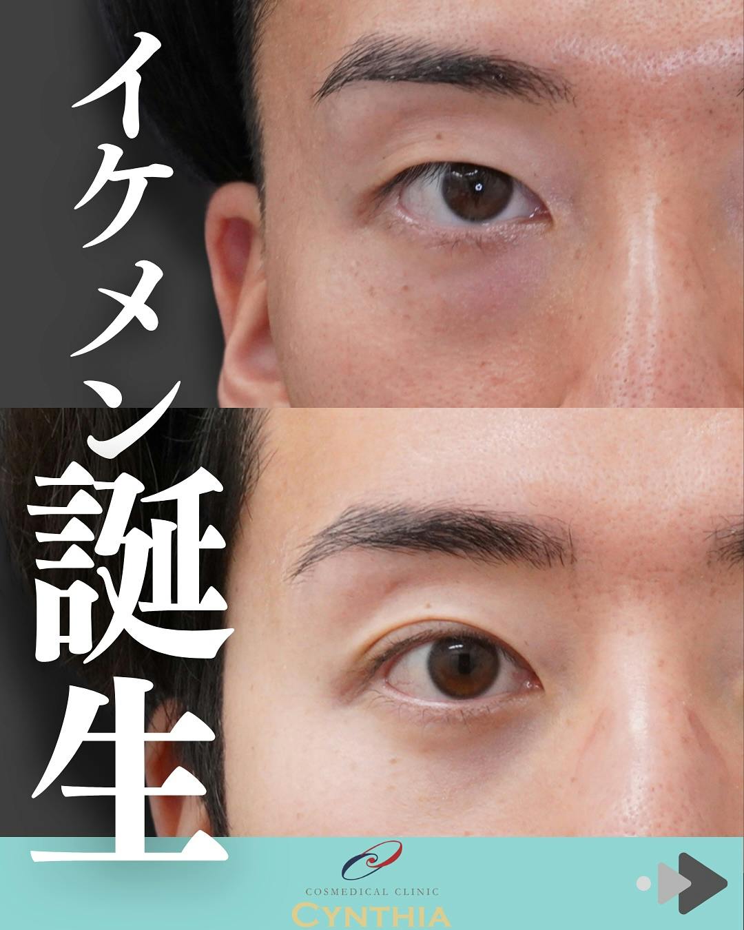 【男性・目元】経結膜脱脂・眼窩脂肪注入・埋没法_before_aftar