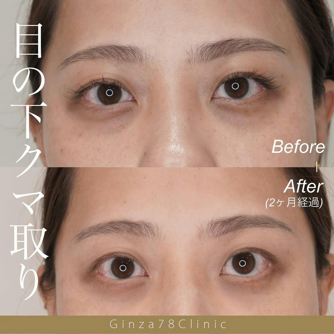 【女性・目元】目の下のクマ取り_before_aftar