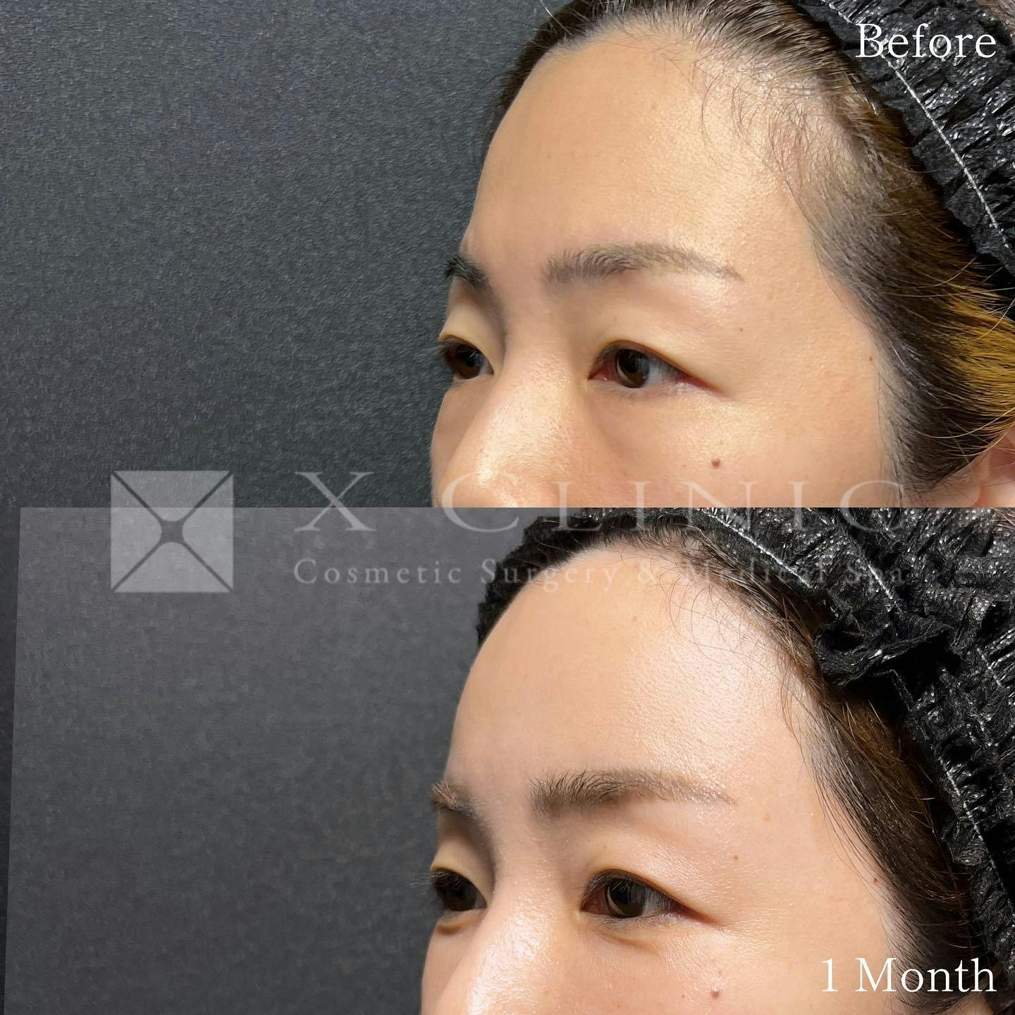 【女性・目元】クマ取りフルコース＋ベイビーおでこ＋PRP_before_aftar