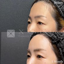 【女性・目元】クマ取りフルコース+ベイビーおでこ+PRP_before_aftar