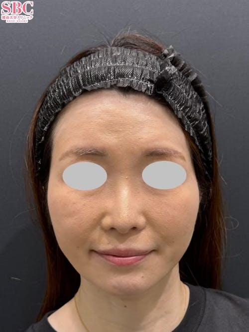 【40代女性・たるみ】メーラーファット除去術_after