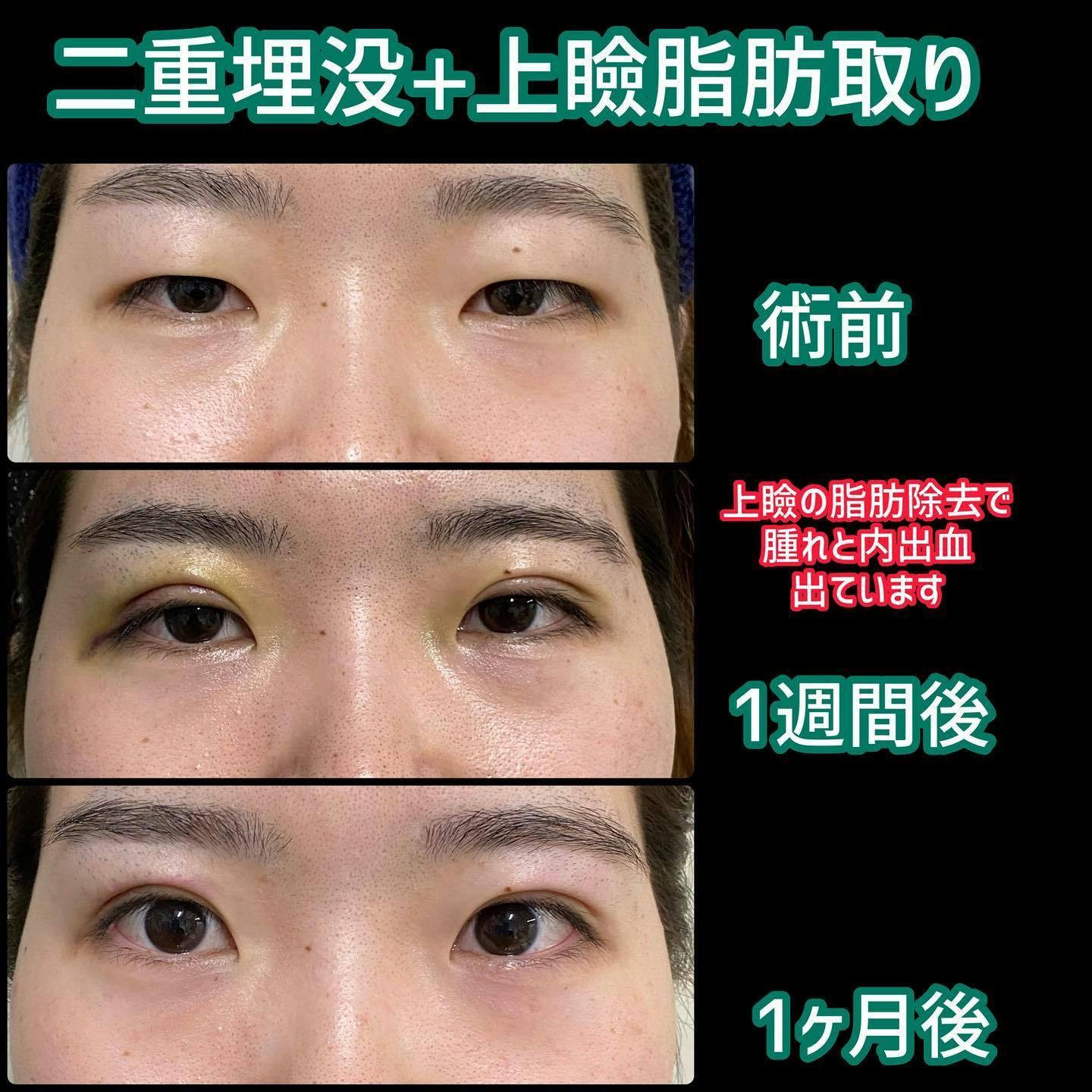 【女性・目元】二重埋没＋上瞼脂肪取り_before_aftar