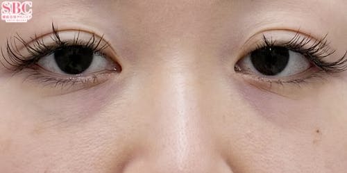 【30代女性・クマ】目の下の切らないクマ・たるみ（ふくらみ）取り、ナチュラル脂肪注射コンデンスリッチ、ナチュラル脂肪注射ナノリッチ_before