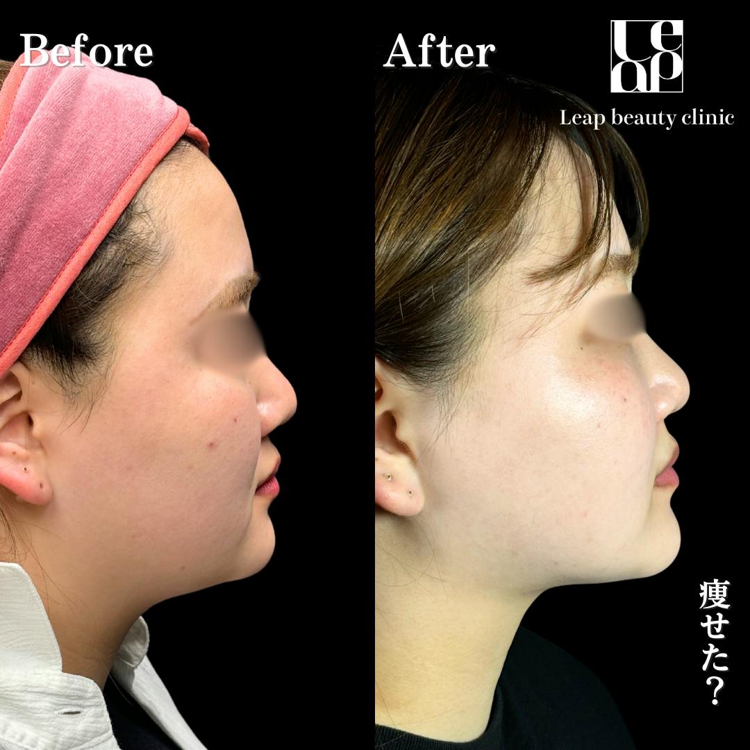 【20代女性・輪郭】頬・顎下脂肪吸引・TESSリフト_before_aftar