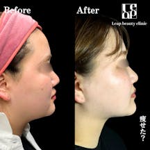 【20代女性・輪郭】頬・顎下脂肪吸引・TESSリフト_before_aftar