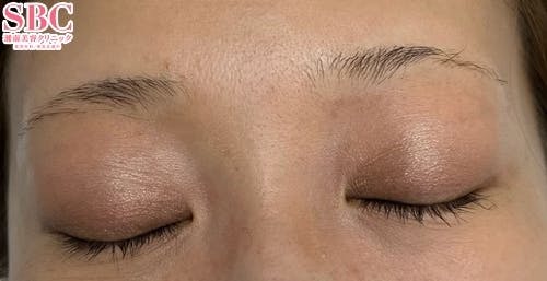 【女性・眉】アートメイク(眉毛)_before