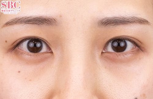 【20代女性・目元】目の下の切らないクマ・たるみ（ふくらみ）取り、ナチュラル脂肪注射コンデンスリッチ、ナチュラル脂肪注射ナノリッチ_after