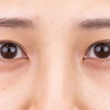 【20代女性・目元】目の下の切らないクマ・たるみ(ふくらみ)取り、ナチュラル脂肪注射コンデンスリッチ、ナチュラル脂肪注射ナノリッチ_after