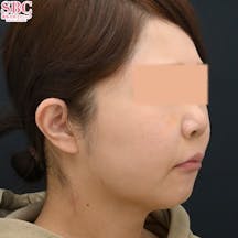 【女性・たるみ】小顔用脂肪吸引注射_after