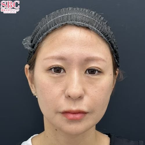 【女性・顔】ヒアルロン酸・女優注射(R)~リジュラン＋ボトックス~・うるおいコラーゲンリフト_after