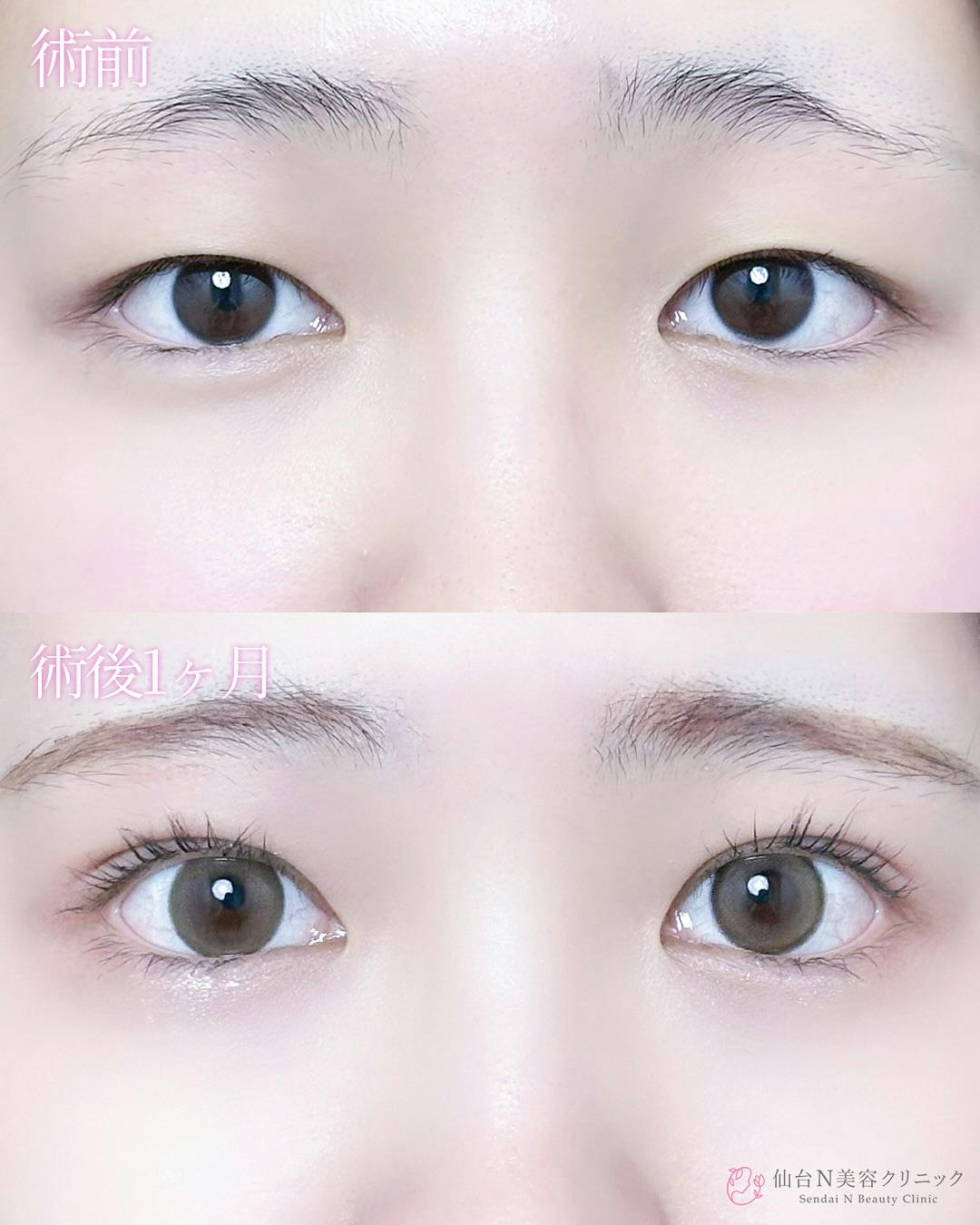 【女性・目元】二重埋没法（シークレットトリプル）_before_aftar