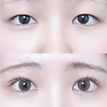 【女性・目元】二重埋没法(シークレットトリプル)_before_aftar
