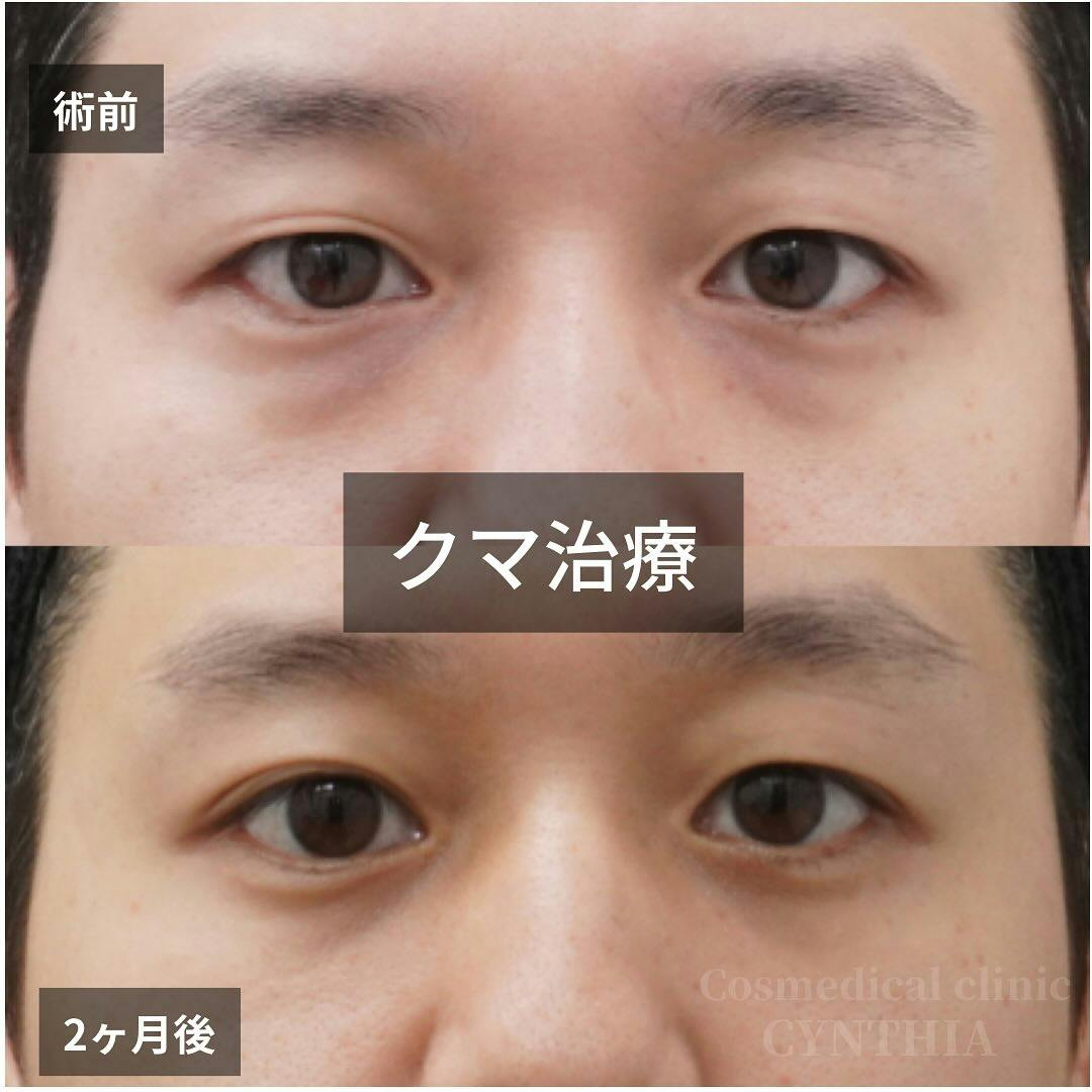 【男性・目元】目の下のクマ・たるみ取り_before_aftar