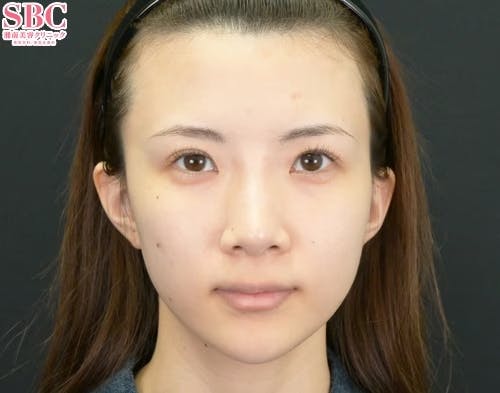 【女性・鼻】小鼻縮小（内側法＋締め付け縫合）_before