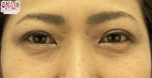 【女性・目元】クイックコスメティーク・ダブルNeo、切らないまぶたのリフトアップ_after