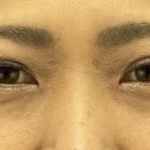 【女性・目元】クイックコスメティーク・ダブルNeo、切らないまぶたのリフトアップ_after