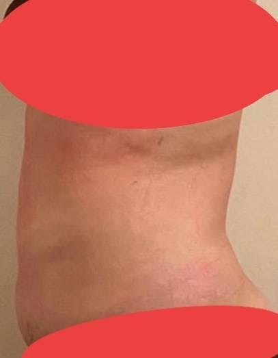 AND美容外科 名古屋院で脂肪冷却：ANDスタンダードを受けたみゆきさんの写真