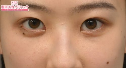 【20代女性・目元】目の下の切らないクマ・たるみ（ふくらみ）取り ナチュラル脂肪注射コンデンスリッチ ナチュラル脂肪注射ナノリッチ_after