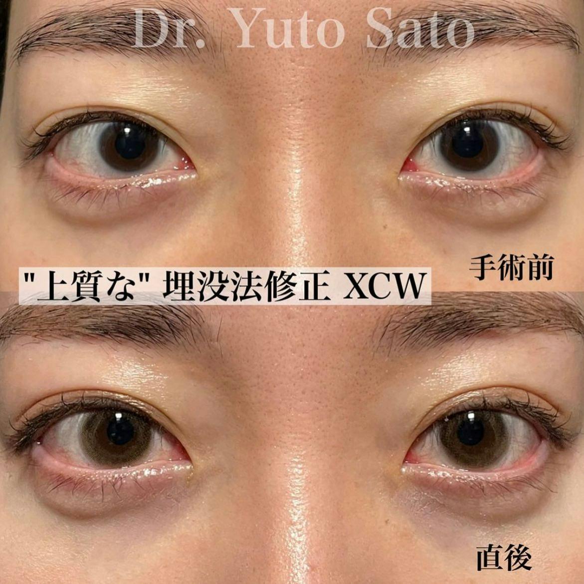 【20代女性・目元】Xクロスダブル_before_aftar