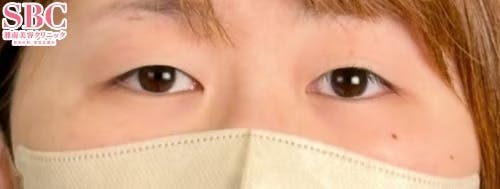 【20代女性・目元】クイックコスメティーク・ダブルNeo_before