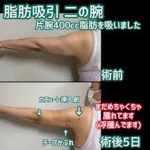 【女性・腕】脂肪吸引二の腕_before_aftar