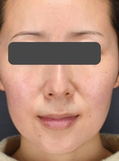 東京美容医療クリニックでエラボトックス・脂肪溶解注射：エラボトックス・脂肪溶解注射を受けたTeTeちゃんさんの写真