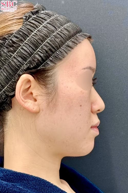 【女性・輪郭】小顔用脂肪吸引注射・ボトックス_before