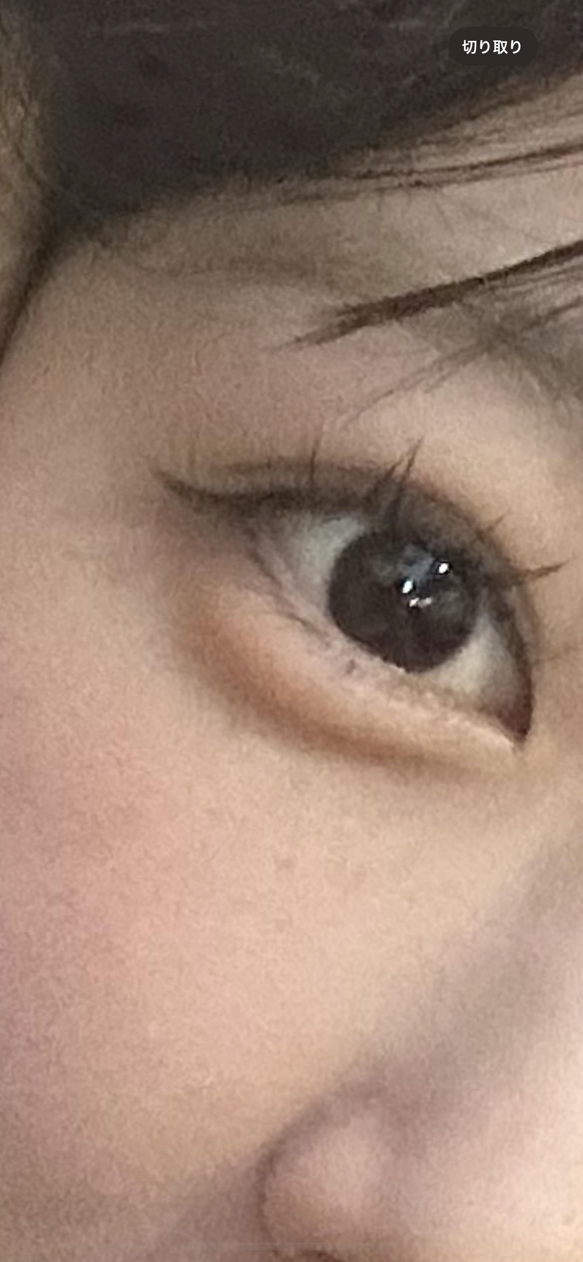 ソルクリニック(SOL CLINIC)で涙袋ヒアルロン酸:涙袋ヒアルロン酸 0.3c cを受けたレイレイさんの写真