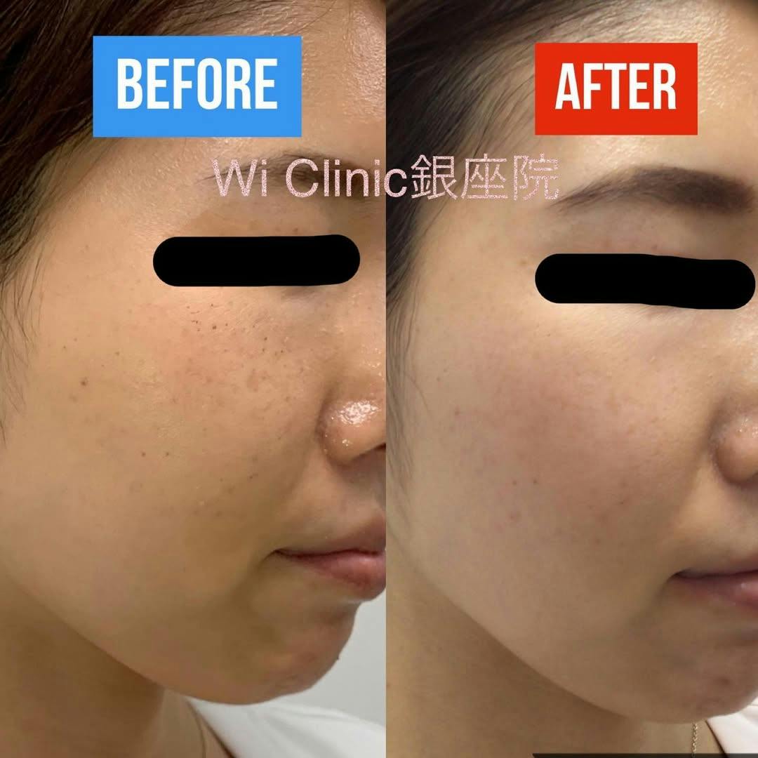 【女性・シミ】アキュライトとアキュプラス_before_aftar