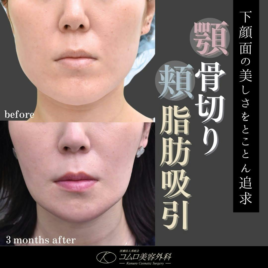 【30代女性・輪郭】顎骨切り・頬脂肪吸引_before_aftar