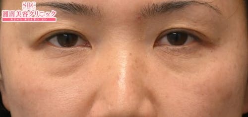 【40代女性・目元】目の下の切らないクマ・たるみ（ふくらみ）取り ナチュラル脂肪注射コンデンスリッチ ナチュラル脂肪注射ナノリッチ_before