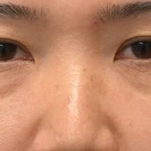 【40代女性・目元】目の下の切らないクマ・たるみ(ふくらみ)取り ナチュラル脂肪注射コンデンスリッチ ナチュラル脂肪注射ナノリッチ_before