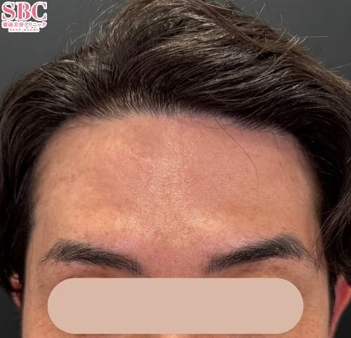 【30代男性・シワ】ボトックス（アラガン）_after