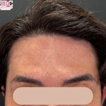 【30代男性・シワ】ボトックス(アラガン)_after