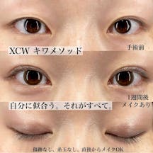 【女性・目元】Xクロスダブル(両目) デカ目術(切らない眼瞼下垂術)_before_aftar